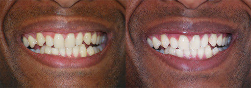 DUO DENTS BLANCHES EN 7 JOURS