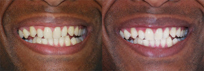 DUO DENTS BLANCHES EN 7 JOURS